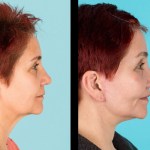 Side view of before and after cheek implants