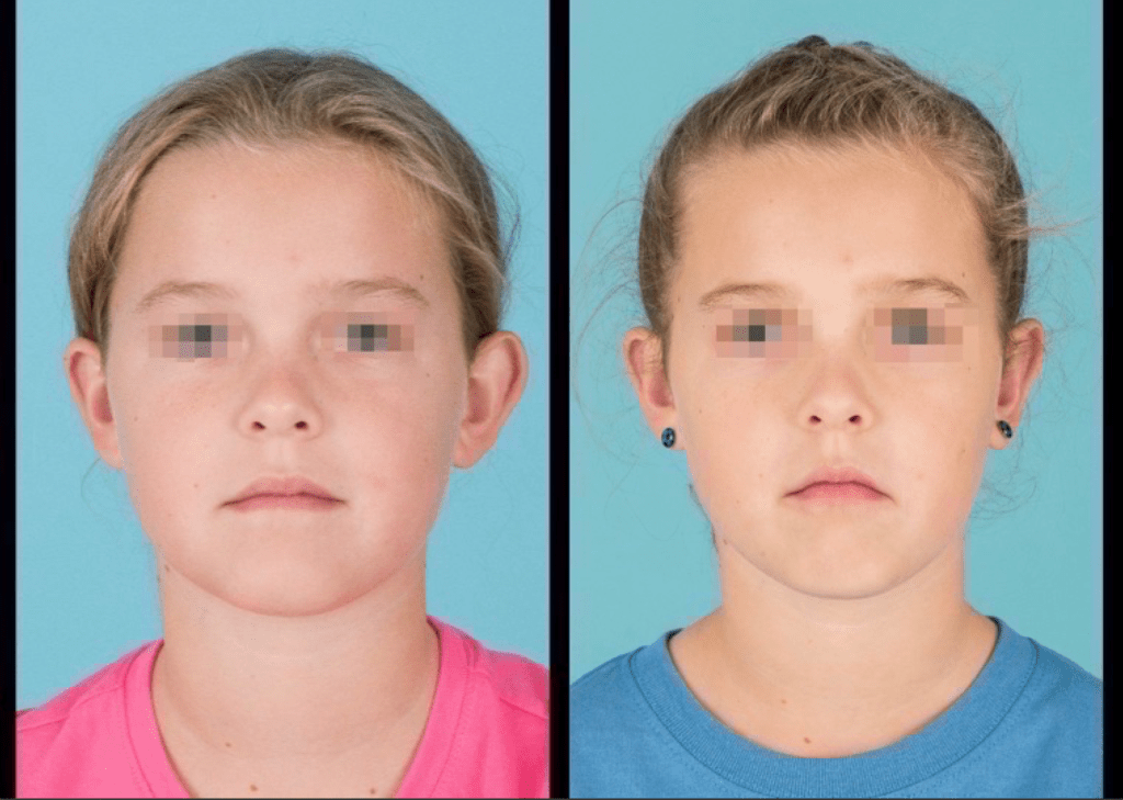 Front view of before and after otoplasty