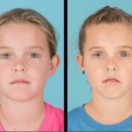 Front view of before and after otoplasty