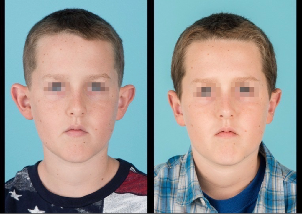 Front view of before and after otoplasty