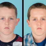 Front view of before and after otoplasty