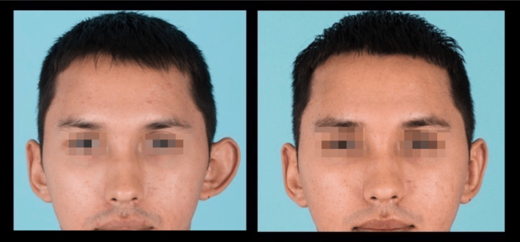 Front view of before and after otoplasty
