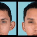 Front view of before and after otoplasty