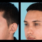 Before and after otoplasty
