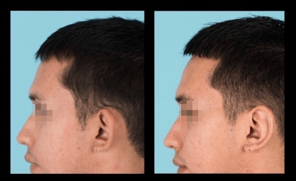 Side view of before and after otoplasty