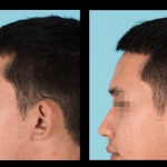 Side view of before and after otoplasty