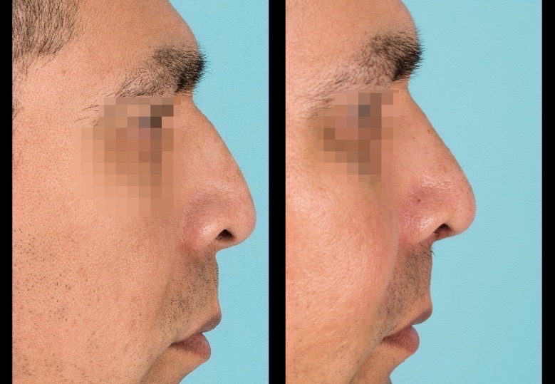 Side view of before and after nose surgery
