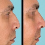 Side view of before and after nose surgery