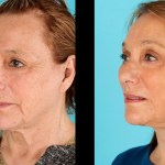 Before and after cheek implants