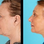 Side view of before and after cheek implants